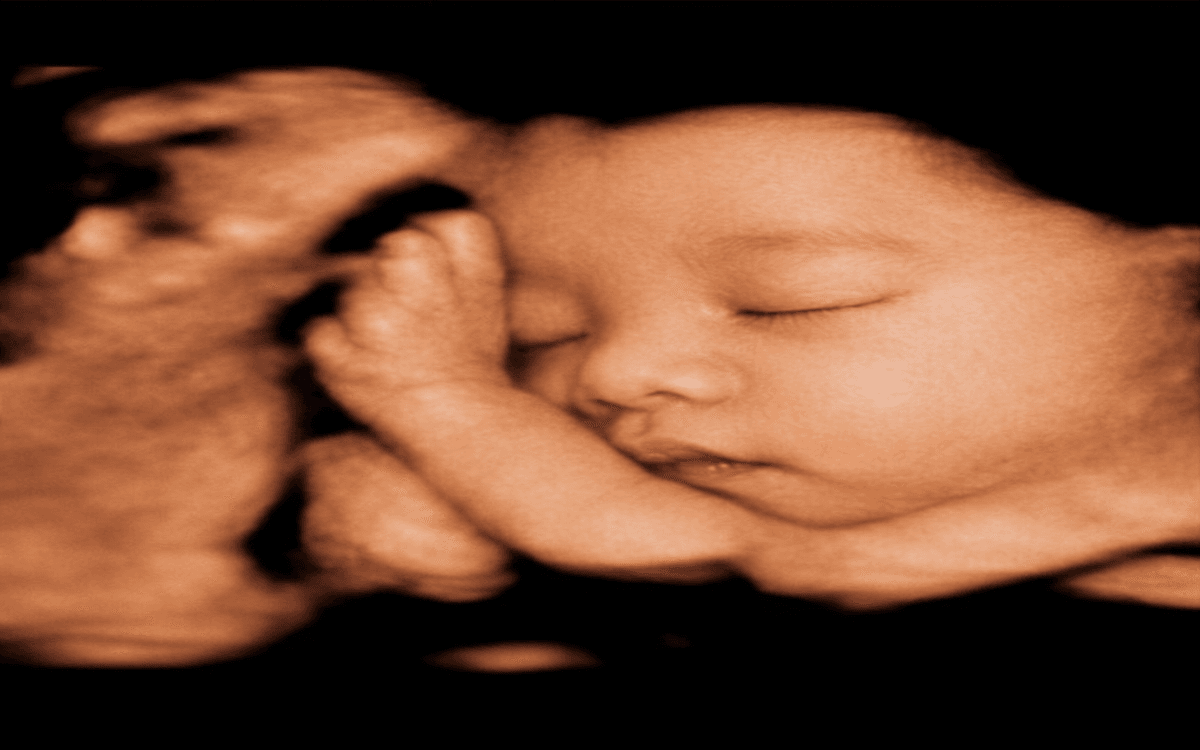 Ảnh siêu âm đã làm nét 1