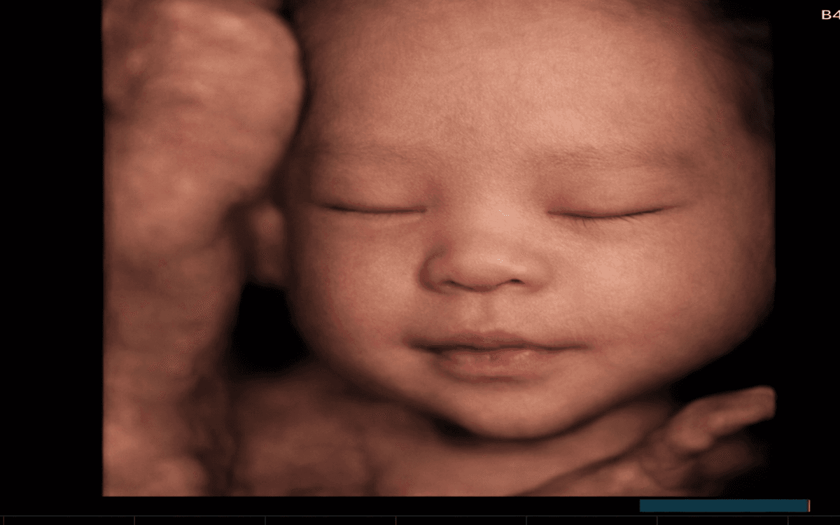 Ảnh siêu âm đã làm nét 2