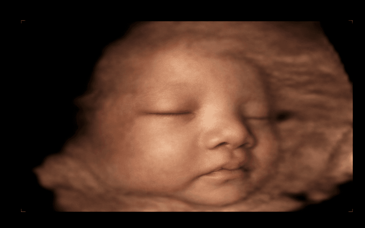 Ảnh siêu âm đã làm nét 3