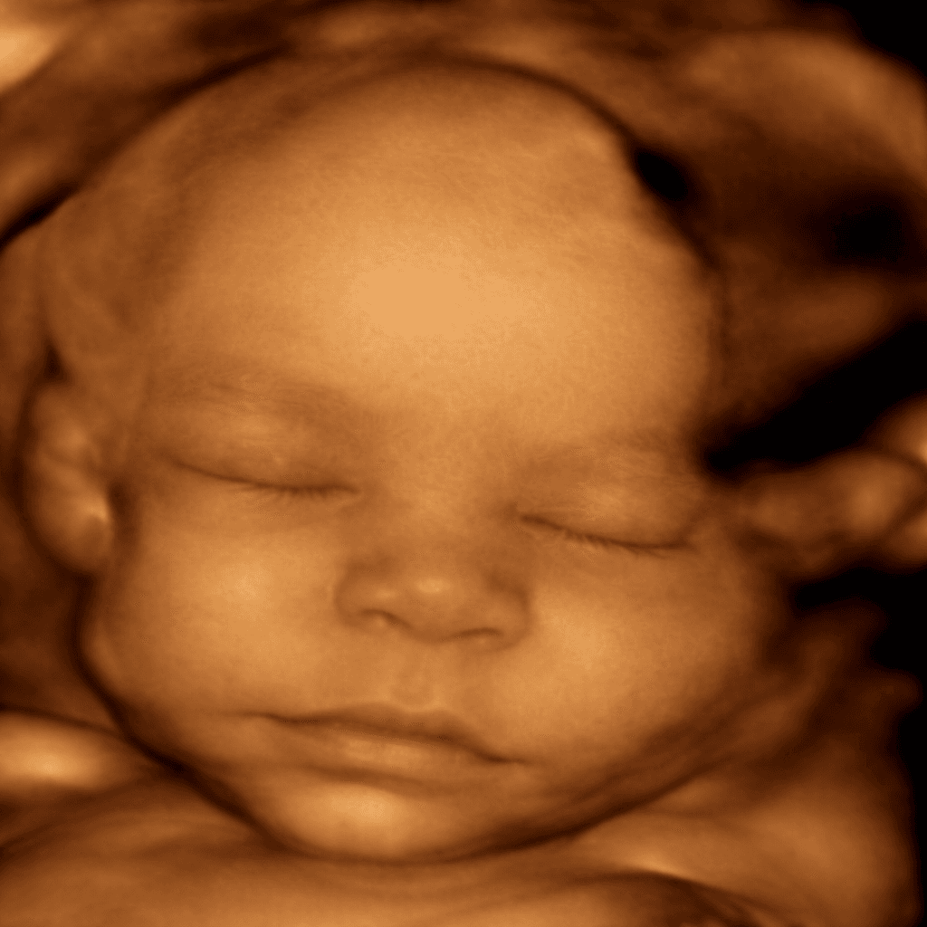 Ảnh siêu âm đã làm nét 7